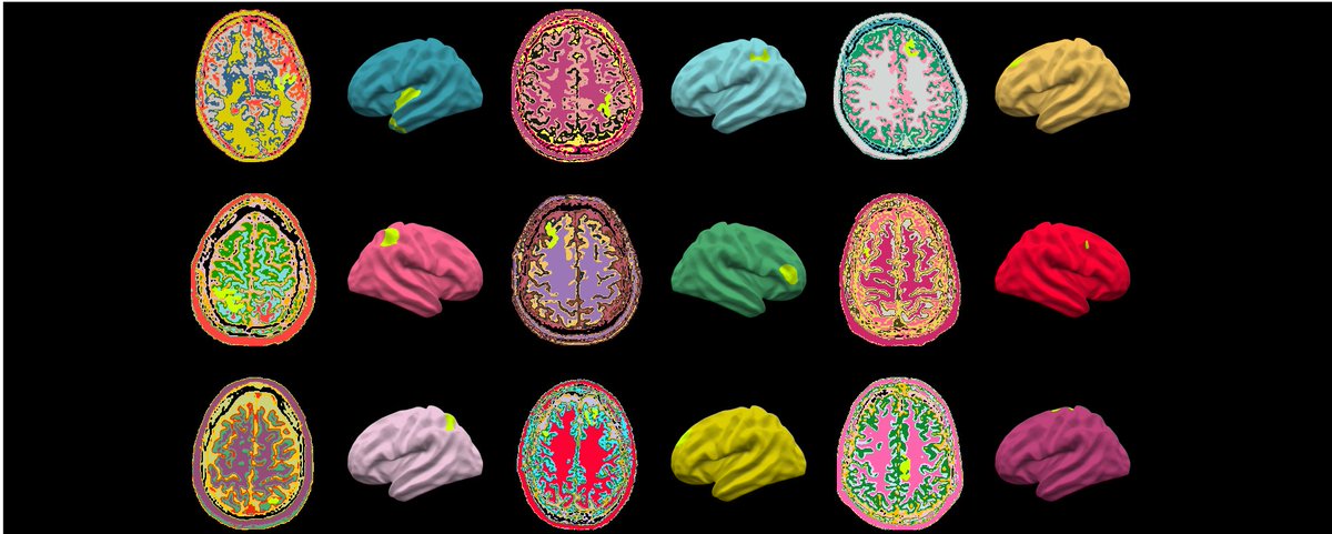 Do you/your child have focal epilepsy?

Take part in this short questionnaire to guide cutting-edge research using BIG DATA, BRAIN IMAGING and ARTIFICIAL INTELLIGENCE to better understand, diagnose and treat people with focal epilepsies. 

forms.gle/8XnD26agnRq91u…