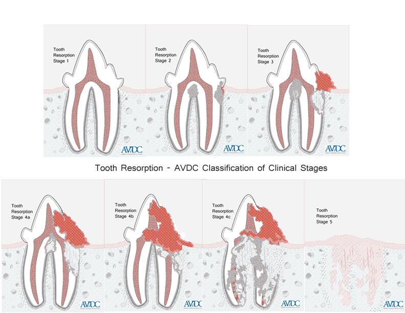 VDFINFO's tweet photo. Feline tooth resorption is a common and painful condition in cats. The cause of this condition is unknown. DAVDC Diplomate, Dr. Josephine Banyard, explains what feline tooth resorption is and how to recognize it in your cat.
https://t.co/PygQYScVNH https://t.co/qSRxs3FJMq