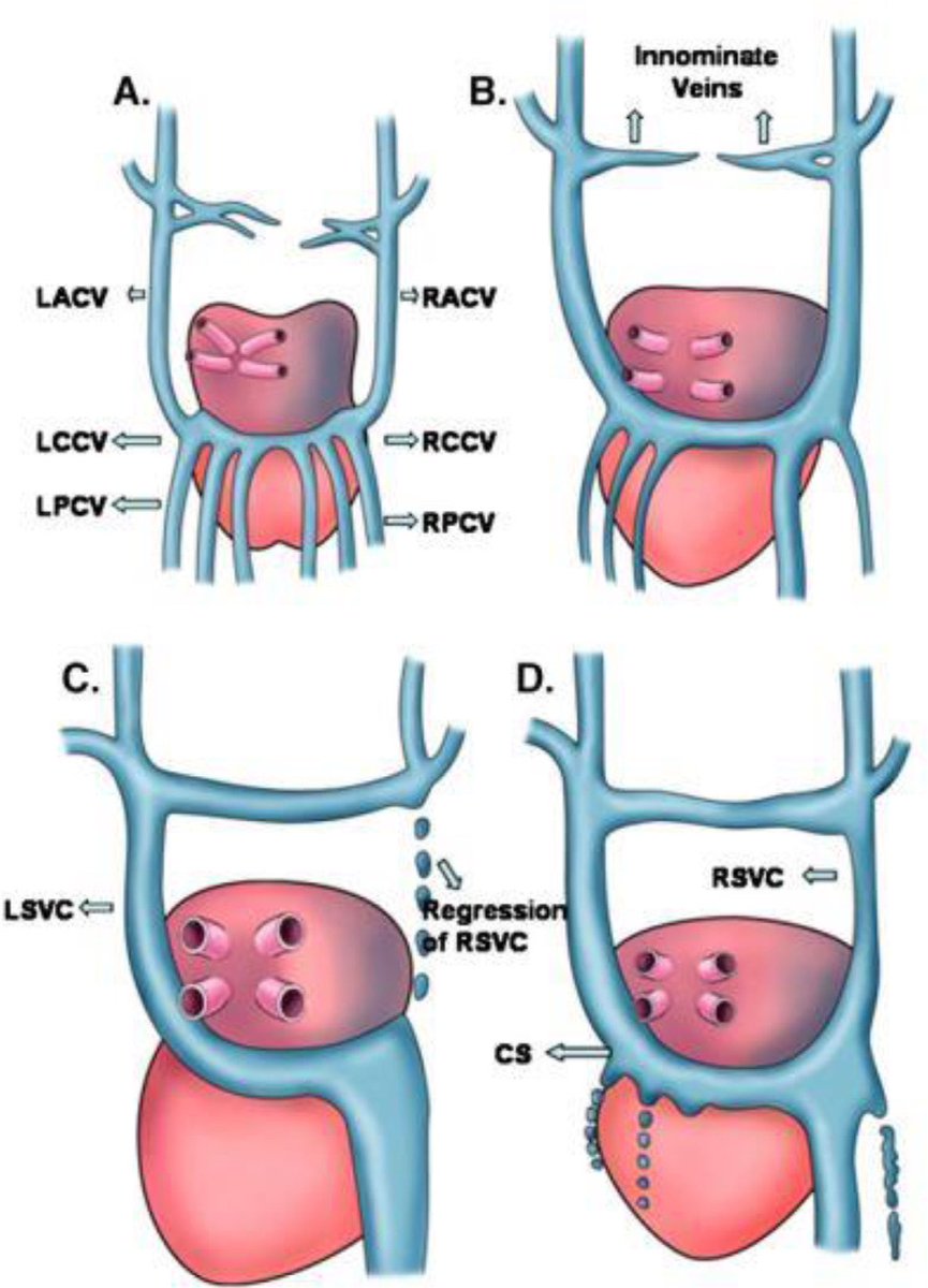 Persistent left superior vena cava: Case report doi.org/10.1016/j.radc… #CardioEd #CardioTwitter #cardiotwiteros #MedEd