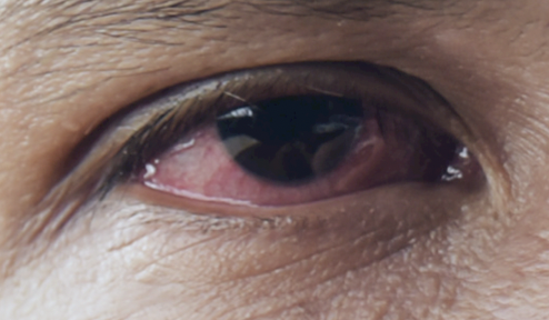 CP_Symposium's tweet photo. "Non-Invasive Imaging Technique May Aid in Earlier Diagnosis of Sjogren's". Read more via @CornealPhys: https://t.co/Gzzo9fxBot https://t.co/oAJL6vEQFX