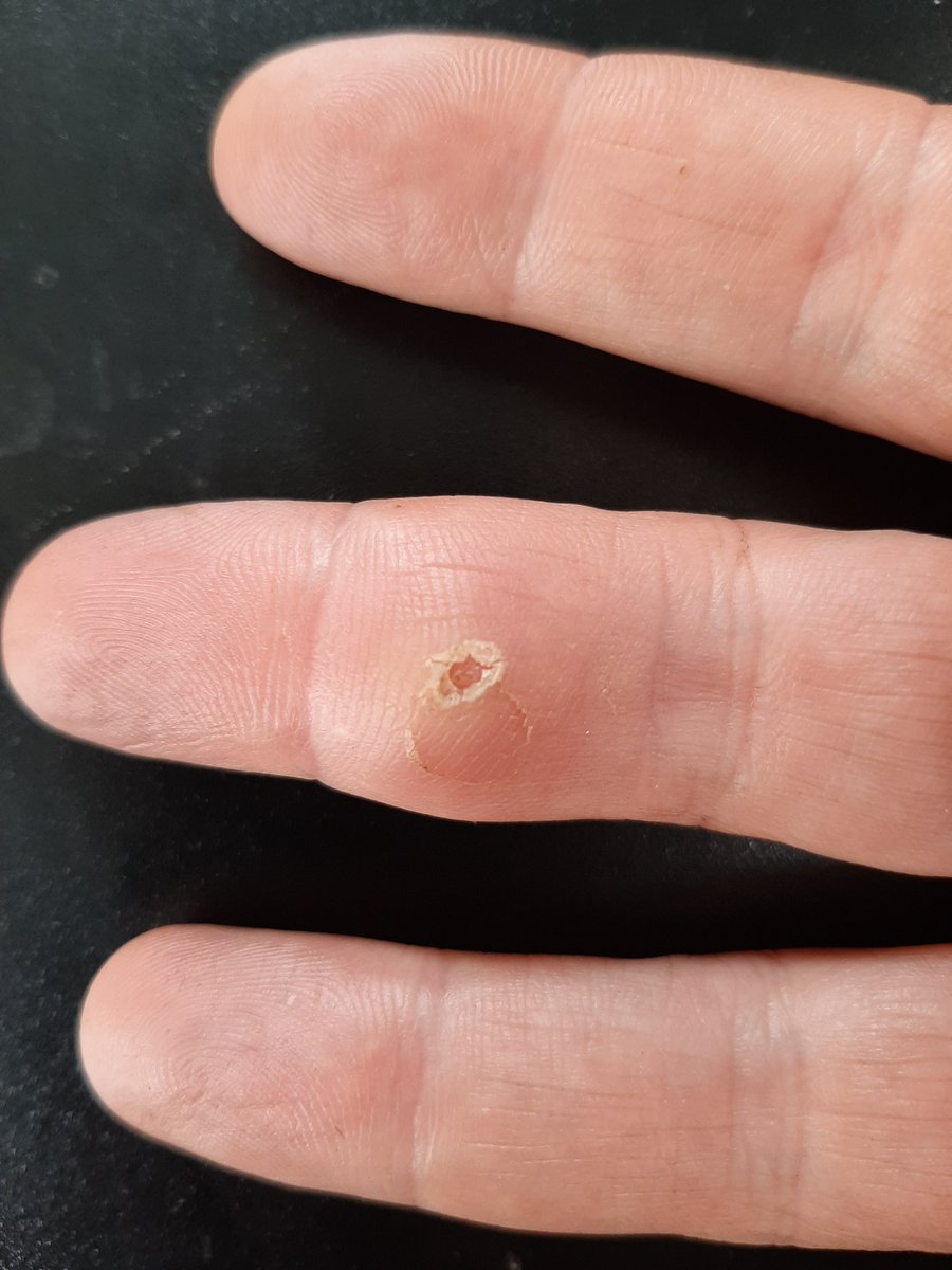 collieennis's tweet photo. Remembering the time I had an unmerciful pain in my finger with non stop, repeat infections and swelling. 
I took a blade to it in frustration one day and discovered a snakes tooth that had been lodged in there for a YEAR unknowns to me! https://t.co/1BzwSTIiqI