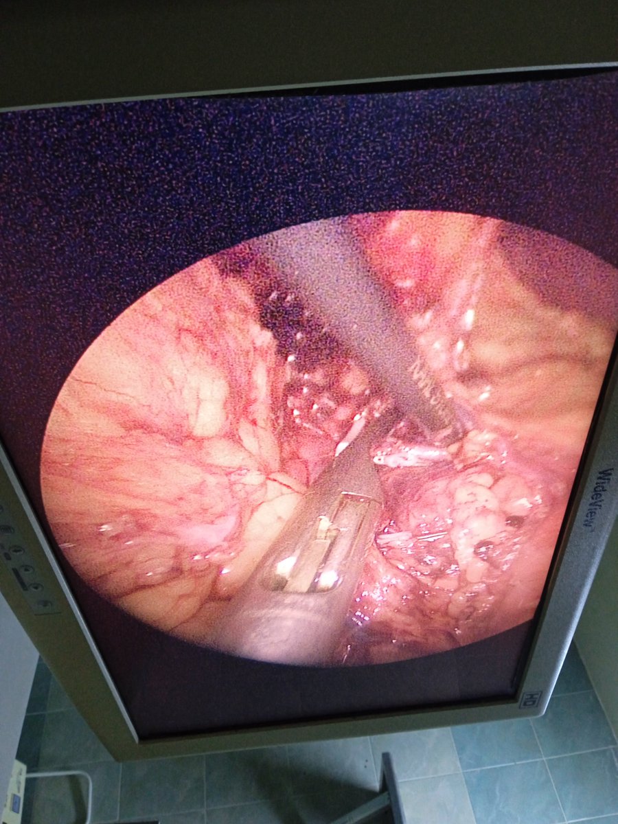 drbabakri's tweet photo. #Lap #nephroureteroctomy 
70 yr F with 4cm Lt lower ureter #TCC causing sever hydrouretronephrosis https://t.co/VnQ3jfOE1O