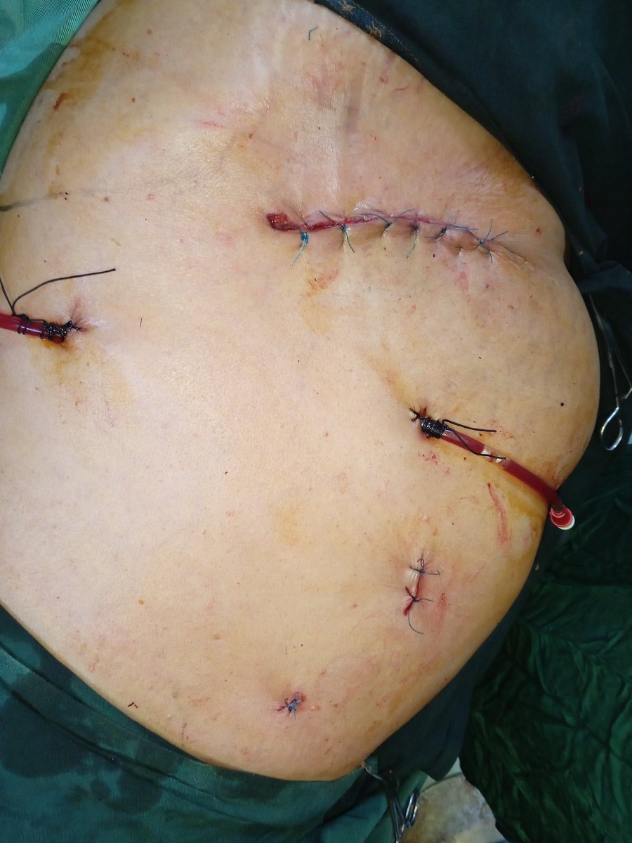 drbabakri's tweet photo. #Lap #nephroureteroctomy 
70 yr F with 4cm Lt lower ureter #TCC causing sever hydrouretronephrosis https://t.co/VnQ3jfOE1O