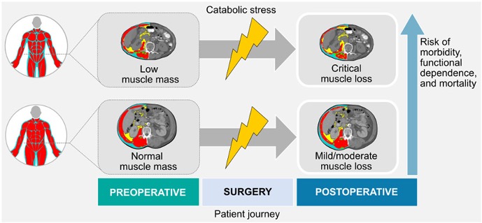 Carla Prado, PhD, RD, FCAHS (@drcarlaprado) on Twitter photo A patient's preoperative nutrition status determines how critical the catabolic response.
Read more here: aspenjournals.onlinelibrary.wiley.com/doi/full/10.10ā¦
<a href="/KathFord_RD/">Katherine Ford</a> <a href="/DrCarlaPrado/">Carla Prado, PhD, RD, FCAHS</a> <a href="/Kryz5559/">M. Cristina Gonzalez</a>
<a href="/LisaMurnane7/">Lisa Murnane</a> <a href="/ChelsiaGillis/">Dr. Chelsia Gillis</a> <a href="/Paul_Wischmeyer/">Paul Wischmeyer MD</a>
<a href="/DL08OMD/">Dileep Lobo</a> A patient's preoperative nutrition status determines how critical the catabolic response.
Read more here: aspenjournals.onlinelibrary.wiley.com/doi/full/10.10ā¦
<a href="/KathFord_RD/">Katherine Ford</a> <a href="/DrCarlaPrado/">Carla Prado, PhD, RD, FCAHS</a> <a href="/Kryz5559/">M. Cristina Gonzalez</a>
<a href="/LisaMurnane7/">Lisa Murnane</a> <a href="/ChelsiaGillis/">Dr. Chelsia Gillis</a> <a href="/Paul_Wischmeyer/">Paul Wischmeyer MD</a>
<a href="/DL08OMD/">Dileep Lobo</a>