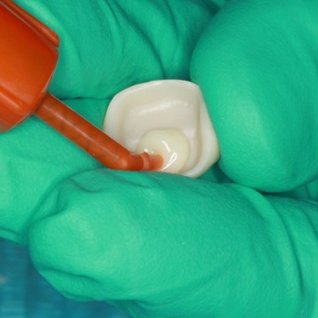 officialcdocs's tweet image. Dr. Mitchell Kim walks through a clinical case using 3M Zirconia and 3M RelyX Universal. You don't want to miss this well documented case presentation!

cdocs.com/discussion-boa…

#cdocs @3MOralCare #cementation #dentist #crownprep