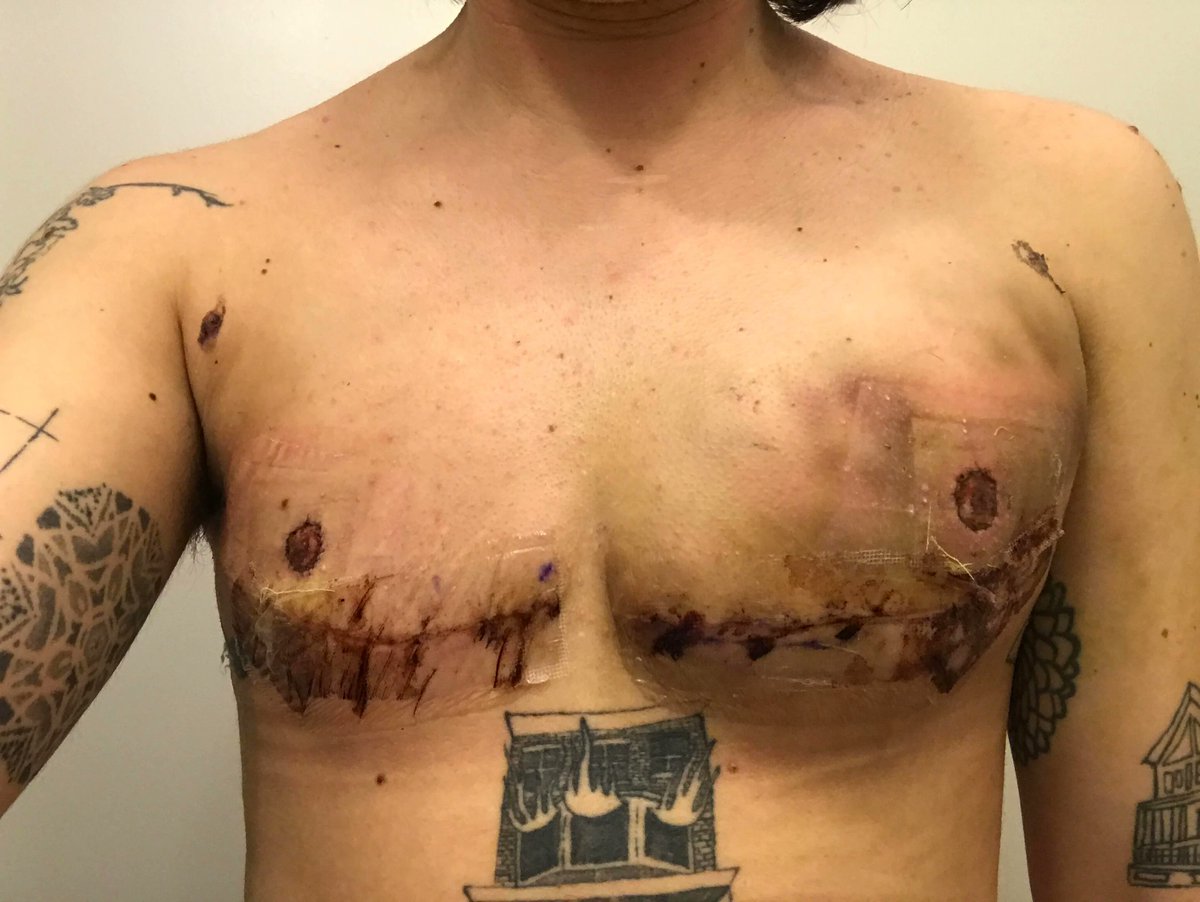 Jamás puede ser "terapia médica" el amputar órganos totalmente sanos porque te molestan psicológicamente. Terapia es asistir y apoyar psicológicamente a esas personas que padecen  trastornos catalogados en el DSM-V. Quien niegue esto es un criminal vende humo.