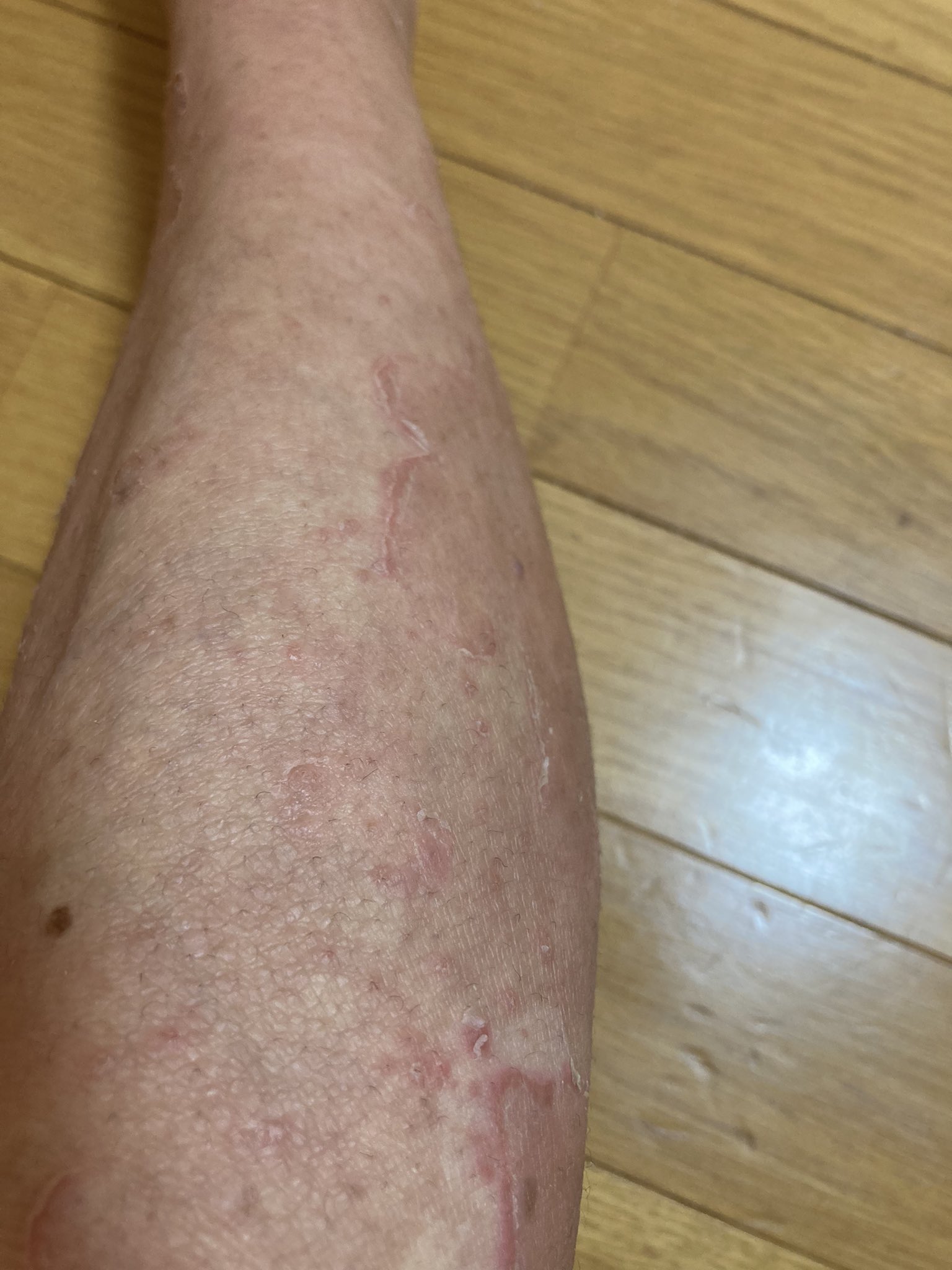 魚鱗癬 Twitter Search Twitter