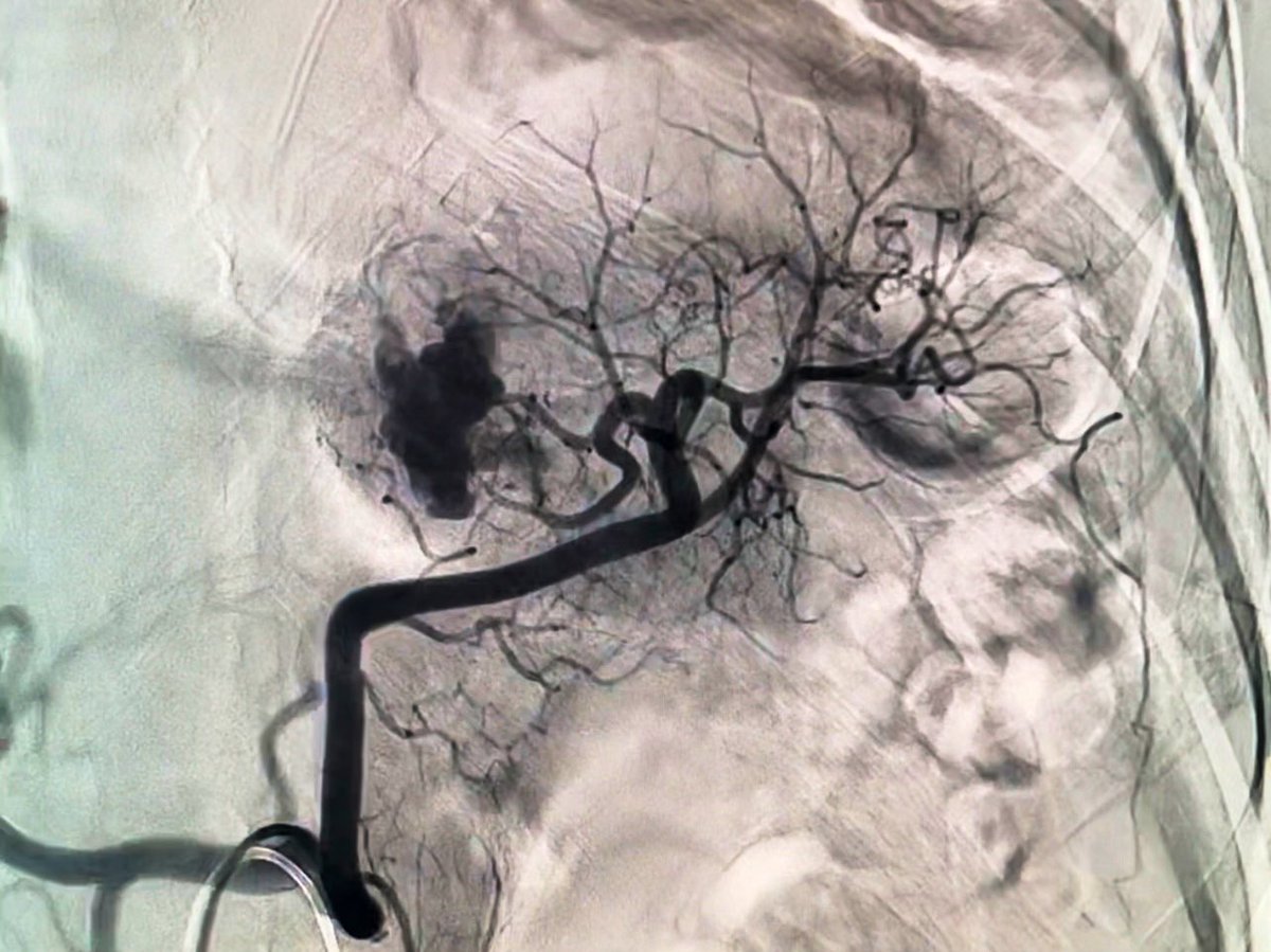 iRadRock's tweet photo. Minimally invasive approach with minimal glue and single coil. Large splenic laceration with active extrav treated by #ViRad can help save a patient from loosing an organ and/or life. @SIR_ECS @SIRspecialists @SIRRFS @ska_ir https://t.co/dzi27d1d3W