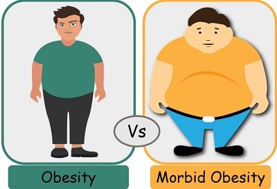 Morbid obesity is a disorder involving excessive body fat that increases the risk of health problems. It is a condition in which the body mass index (BMI) higher than 35. 
#morbidobesity #excessfat #highbodymassindex #BMI #endocrinology