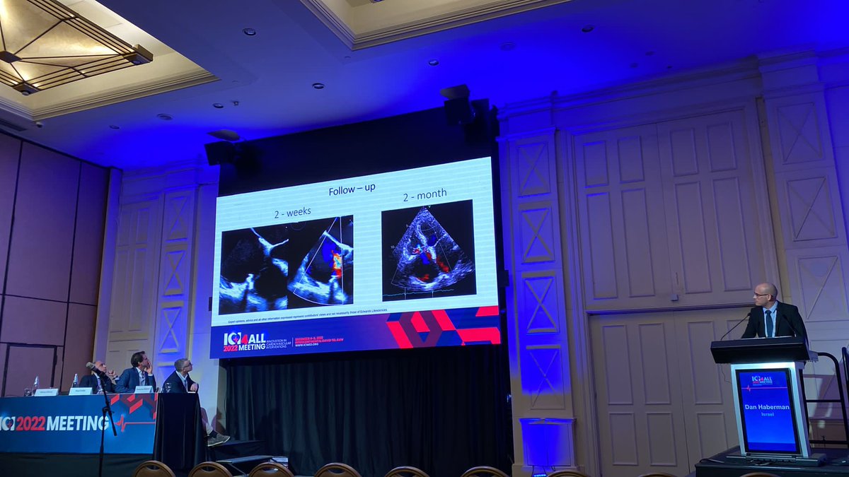 Dan Haberman (@haberdan) on Twitter photo Presenting TV annuloplasty with Cardioband for patient with torrential TR and extreme coaptation gap (vc=22mm) in “my crazy Mital / Tricuspid” session, ICI 2022, TLV, Israel. And what a panel! <a href="/drmaisano/">francesco maisano</a> <a href="/PaulFefer/">Paul Fefer</a> <a href="/MShuvy/">Mony Shuvy</a> Presenting TV annuloplasty with Cardioband for patient with torrential TR and extreme coaptation gap (vc=22mm) in “my crazy Mital / Tricuspid” session, ICI 2022, TLV, Israel. And what a panel! <a href="/drmaisano/">francesco maisano</a> <a href="/PaulFefer/">Paul Fefer</a> <a href="/MShuvy/">Mony Shuvy</a>