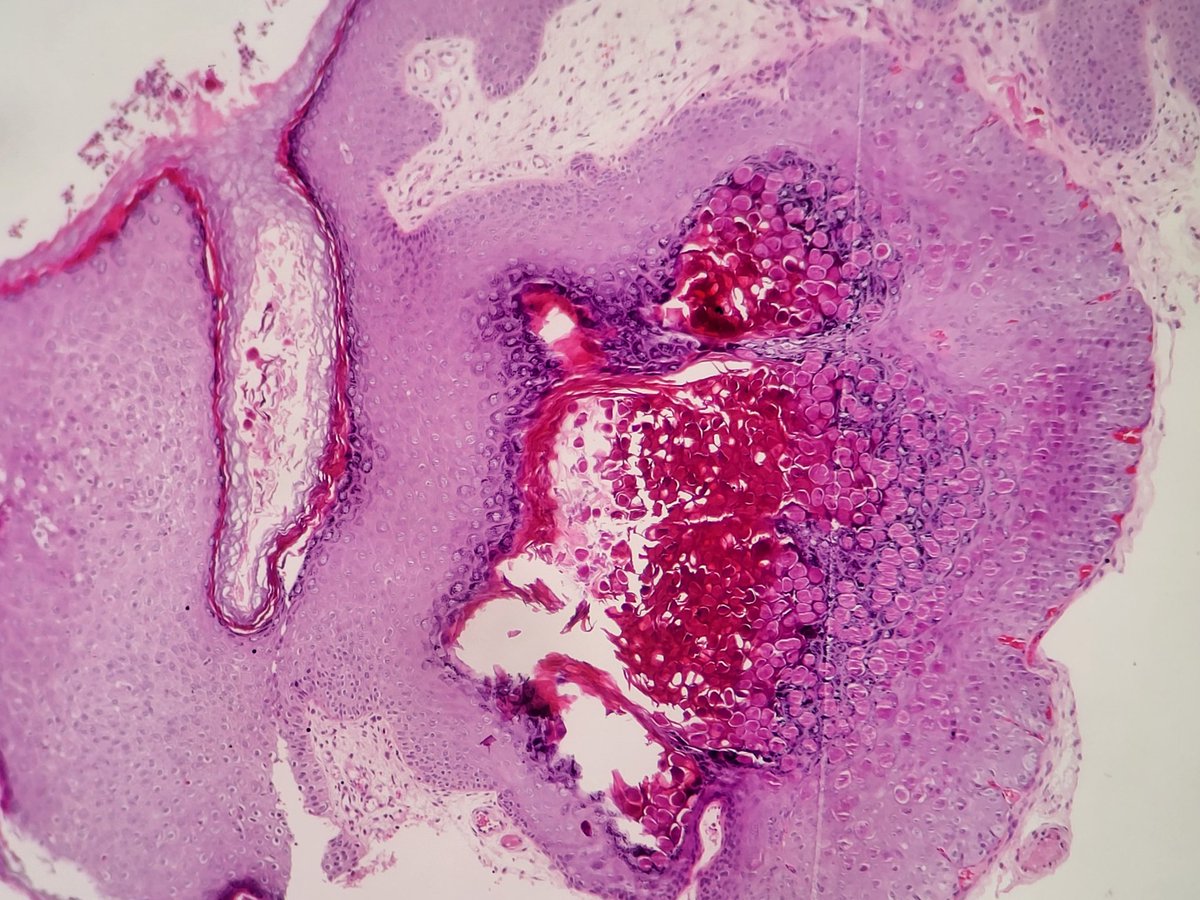 D4L14H's tweet photo. Multiple skin lesions.
@aymanmunshy
Spot diagnosis case for #pathboard exams.
#dermpath #pathology https://t.co/nNmkGM19sB