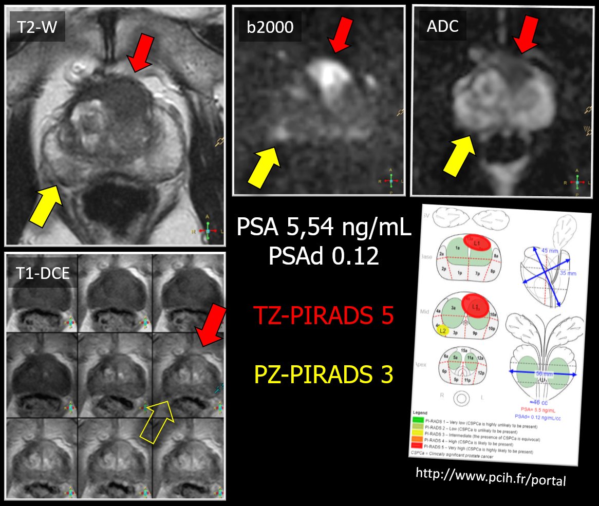 Patient with AFMS-PIRADS 5 lesion, associated with a PZ-PIRADS 3 at #MRI. Systematic biopsies only showed 1mm ISUP 1 microfocus on the right PZ, but target biopsies revealed 2x10mm of ISUP 1 #prostate #cancer in the AFMS
#GUImaging #greatradiologyresidents