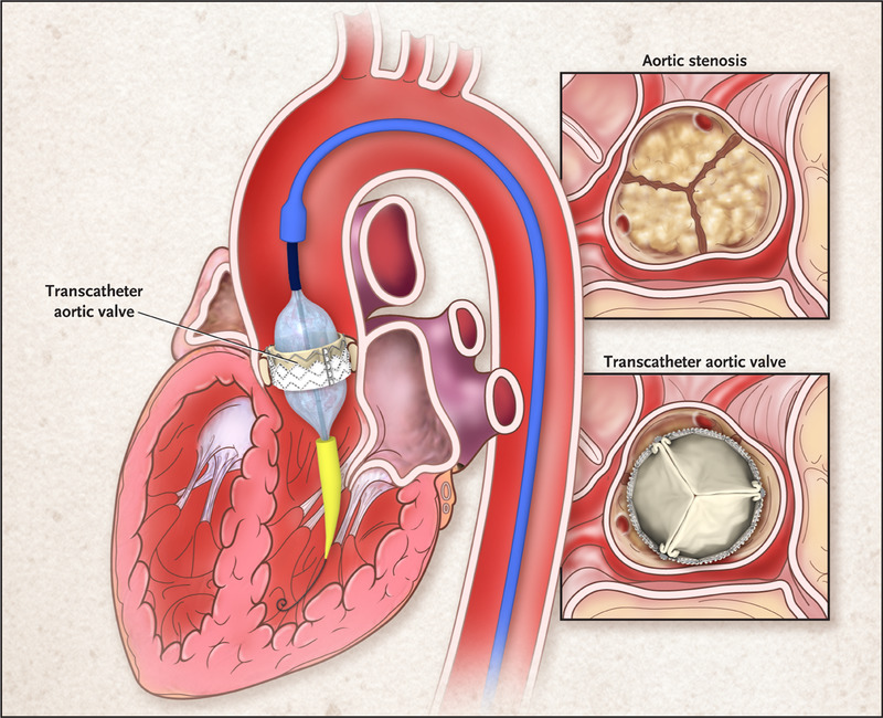 Surging Applications Of #Mechanical #Valves Are Projected To Drive The Growth Of #HeartValveDevices Market
More @ 5mp2.short.gy/3g3oo1
#Hospitals #heartdevies #cardioequipments #medical