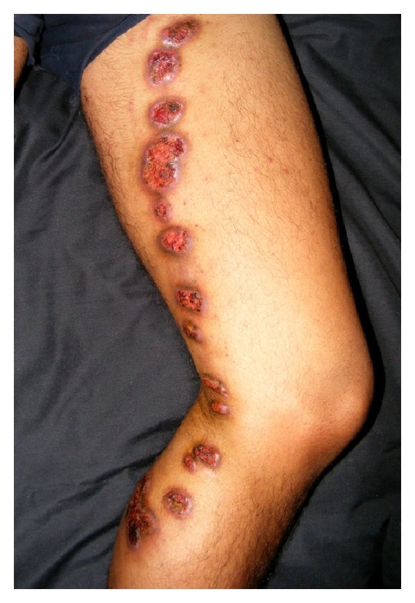 SuperM006's tweet photo. A farmer after an injury complaints of ulcerative lesion as shown below dx? 
#MedTwitter 
@Sthanu5 https://t.co/oihEVFuDVs