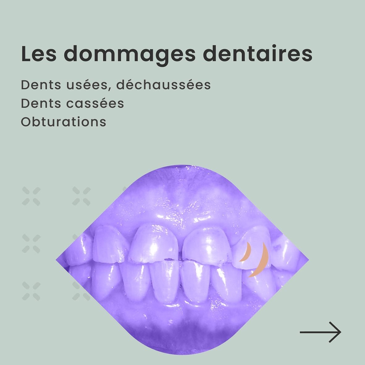 bruxless's tweet photo. Les conséquences du bruxisme sont multiples:

Dommages dentaires
Dents usées, déchaussées, cassées ou obturations 

Douleurs faciales
Maux de tête, douleur mâchoire, oreilles et muscles environnants

Sommeil perturbé
Insomnie, nuit agitée 

#bruxisme #insomnie #migraines #sommeil https://t.co/aVnES5VpIc