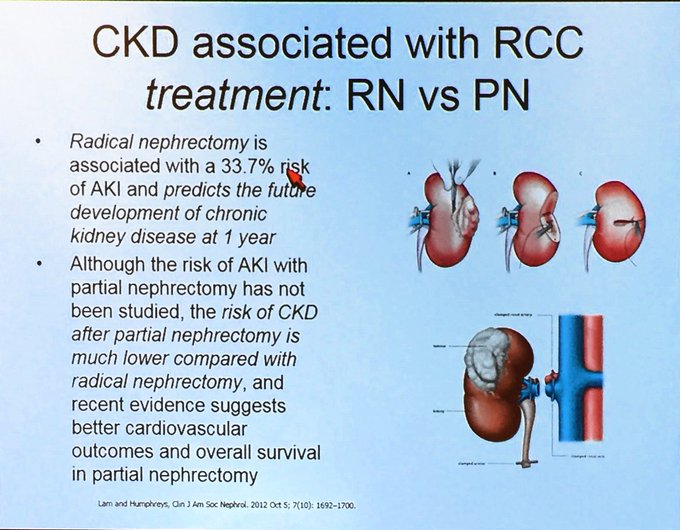 Tejas Desai, MD, MBA (@nephondemand) on Twitter photo 3/
This team also highlights the need to identify patients *at risk* for CKD at the time of a nephrectomy. See the work of <a href="/kdjhaveri/">Kenar Jhaveri</a> <a href="/VBijol/">Vanesa Bijol</a> <a href="/purvasharma821/">purva sharma</a> & <a href="/Yihe28745445/">Yihe Yang</a>
<a href="/renalpages/">Jyoti Baharani</a> also covered CKD & RCC at the <a href="/ASNKidney/">American Society of Nephrology</a> #KidneyWk meeting.
sites.google.com/view/nephrowor… 3/
This team also highlights the need to identify patients *at risk* for CKD at the time of a nephrectomy. See the work of <a href="/kdjhaveri/">Kenar Jhaveri</a> <a href="/VBijol/">Vanesa Bijol</a> <a href="/purvasharma821/">purva sharma</a> & <a href="/Yihe28745445/">Yihe Yang</a>
<a href="/renalpages/">Jyoti Baharani</a> also covered CKD & RCC at the <a href="/ASNKidney/">American Society of Nephrology</a> #KidneyWk meeting.
sites.google.com/view/nephrowor…
