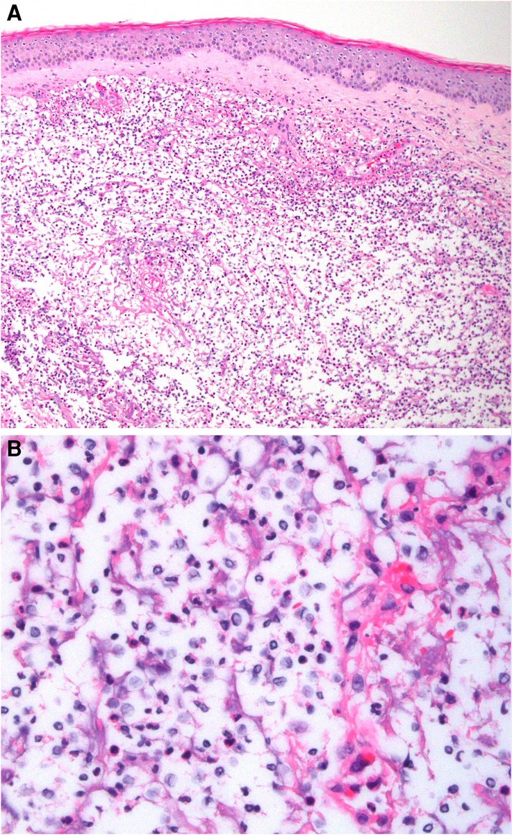 An important mimic of cutaneous cryptococcal disease - a collaboration between @EmoryInfectDis <a href="/EmoryPathology/">Emory University Department of Pathology</a> <a href="/EmoryDerm/">Emory Dermatology</a> including <a href="/ariel_jordan22/">Ariel Jordan, MD</a> <a href="/StewartGNeill/">Stewart G. Neill</a> <a href="/realJeffCollins/">Jeff Collins</a>