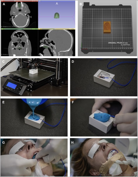 #ONSNew A Patient-Specific Reference Tracker for Noninvasive Electromagnetic Navigation of Endoscopic Skull Base Surgery bit.ly/3PbZwoQ by @AlexMickoMD @MedUni_Wien @MdOlabisi @Zaazoue @e_celano @CNS_Update @haboualshaar @DKondziolkaCNS  #SkullBase #Oraltracker