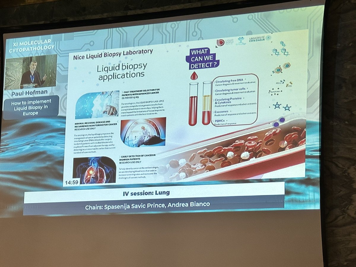 Paul Hofman on implementing #liquidbiopsy in #lungcancer Fascinating talk on how to test relevant #biomarkers to best serve our patients