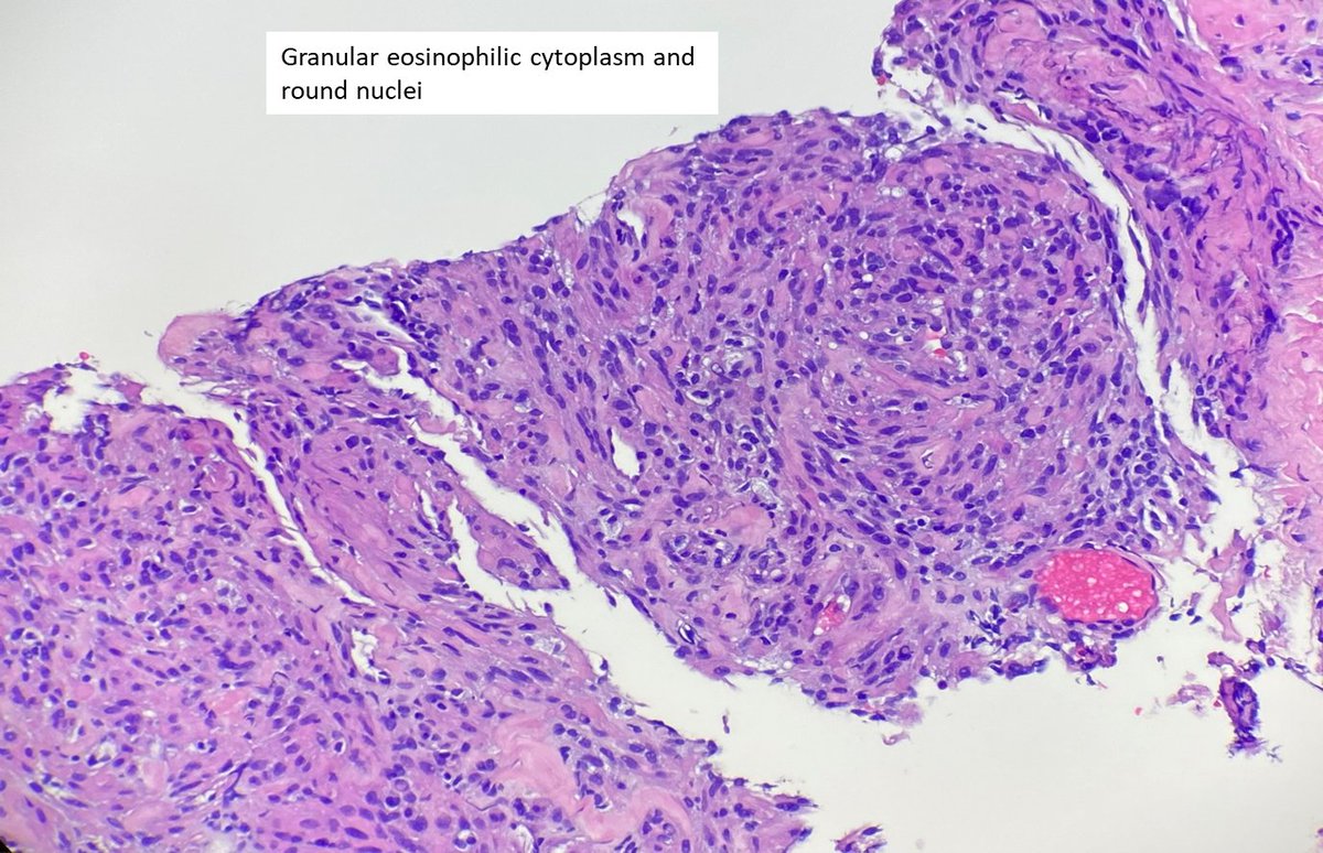 AnnieGarciaMD's tweet photo. This is an example of a Sclerosing PEComa. Neoplastic cells form cords, nests and trabeculae within a dense collagenous stroma. They show eosinophilic cytoplasm and round nuclei. This subtype is usually not associated with tuberous sclerosis #bst_path #PathTwitter #BSTpath https://t.co/Lvm56LOIvA