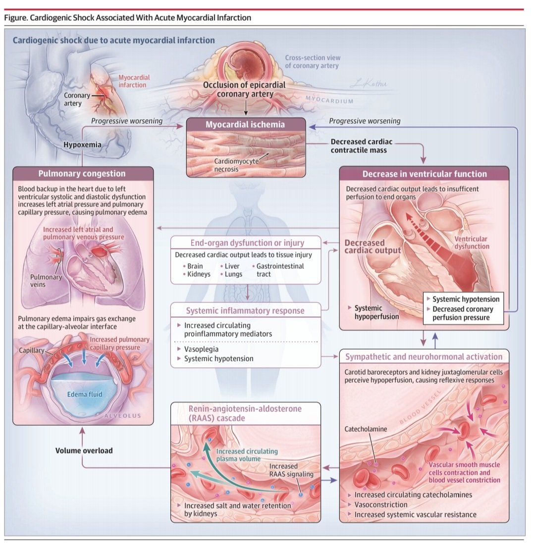 javier20ch's tweet photo. Choque cardiogénico por IAM.🫀💥
✨️La revisión más completa del tema por @JAMA_current 🔝👌 

✅️Repaso de fisiopatología, clínica, Dx y Tto.✍️
✅️Repaso de toda la evidencia hasta la actualidad: SHOCK, TRIUMPH, CULPRIT, IABP I-II, IMPRESS.📑
💎🧐👌💯
https://t.co/VjvqsvXeHZ https://t.co/F97kcxr74j