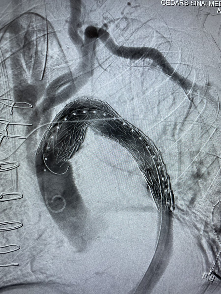 Total arch with frozen elephant trunk for type A repair facilitates subsequent TEVAR for the residual type B dissection from our multidisciplinary aortic team @CedarsSinai @VascularSurgCS @DrAliAzizzadeh @LizChou @SallySchonefeld @pacman8it @DrBowdish