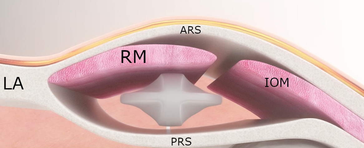 ArielZisman's tweet photo. In men with inaccessible bilateral inguinal rings, reservoir placement in a submuscular rectus space is an easily reproducible and safe alternative at the time of inflatable penile prosthesis placement
Thank you @valenzuela_uro 

https://t.co/4h0gNC2l8q

@SMSNA_ORG @essm_tweets https://t.co/okg2v5HQyV
