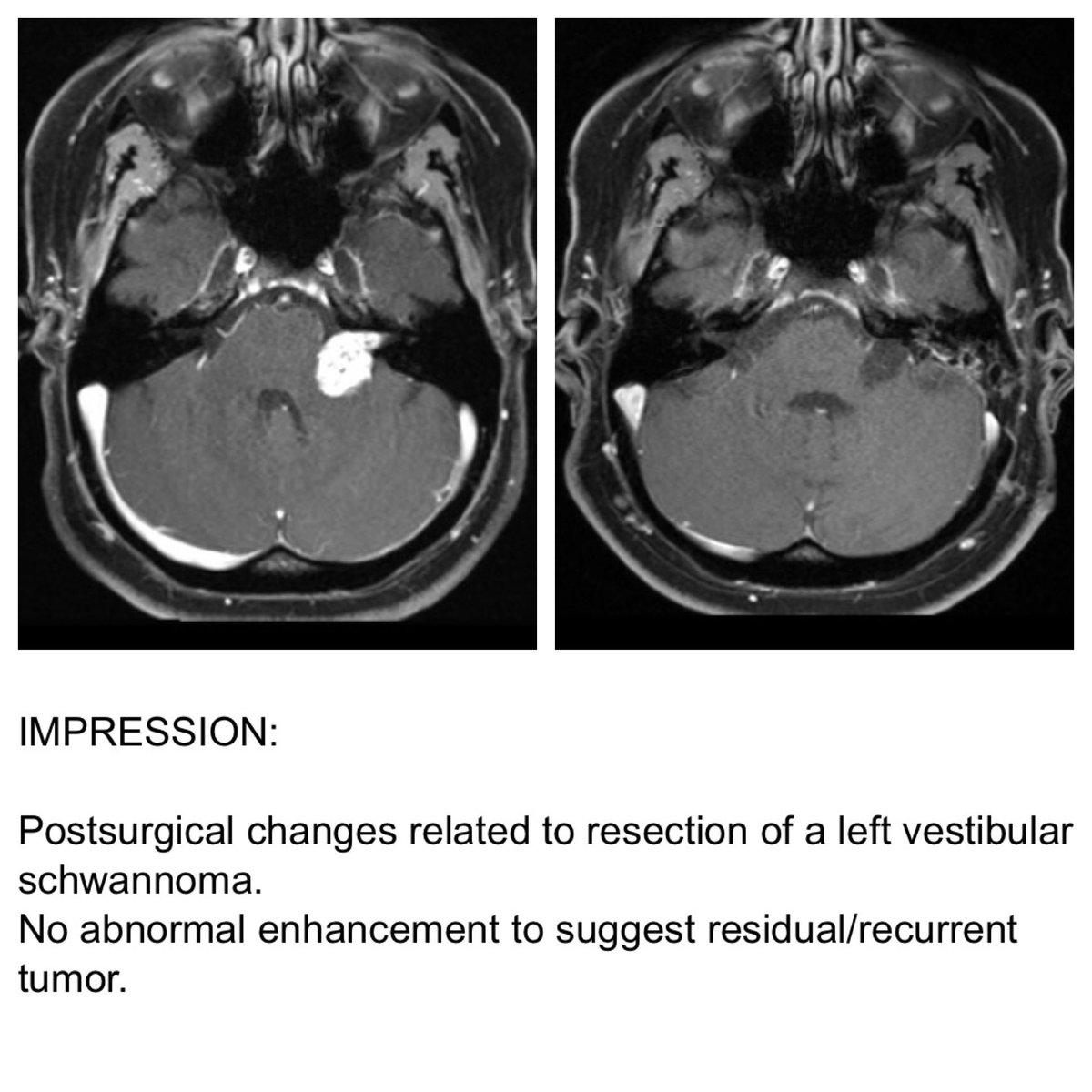 dmcaputo's tweet photo. We are officially tumor-free, my friends! #brainsurgery #acousticneuroma #anwarrior #warrior #acousticneuromawarrior #translab
🎉🧠🎉🧠🎉🧠🎉🧠🎉 🧠 https://t.co/HjTanrgcuI