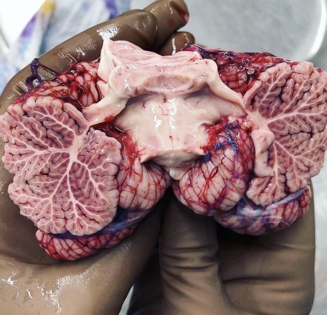 Fascinating photo of the brain.

Credits: <a href="/DrLuismorales90/">Luis A. Morales Ojeda, M.D</a> 

#neuroscience #MedTwitter