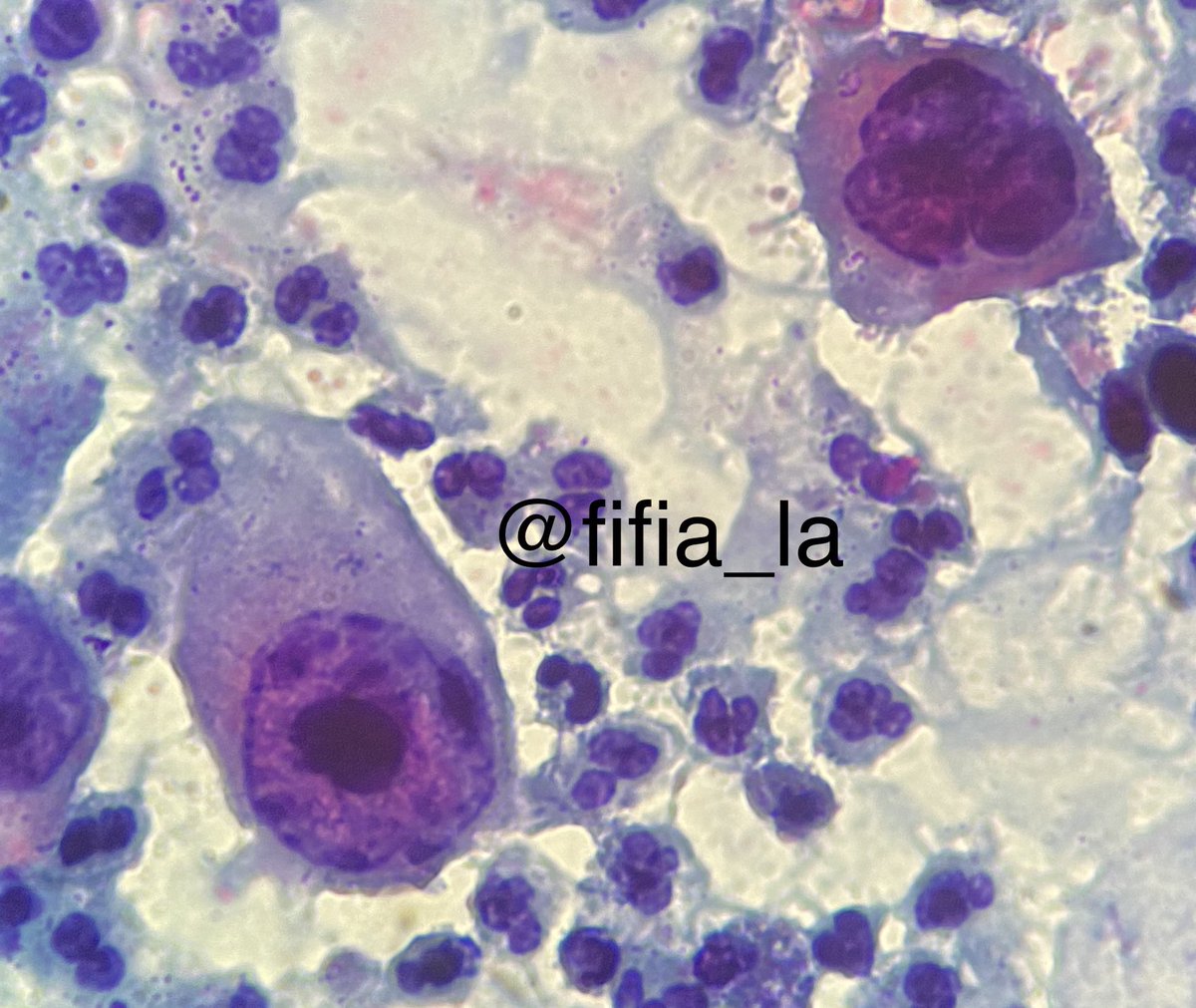 fifia_la's tweet image. Citología cervicovaginal convencional 
#SquamousCellCarcinoma #keratinization 
#TadpokeCells #Macronucleolous #PapSmear