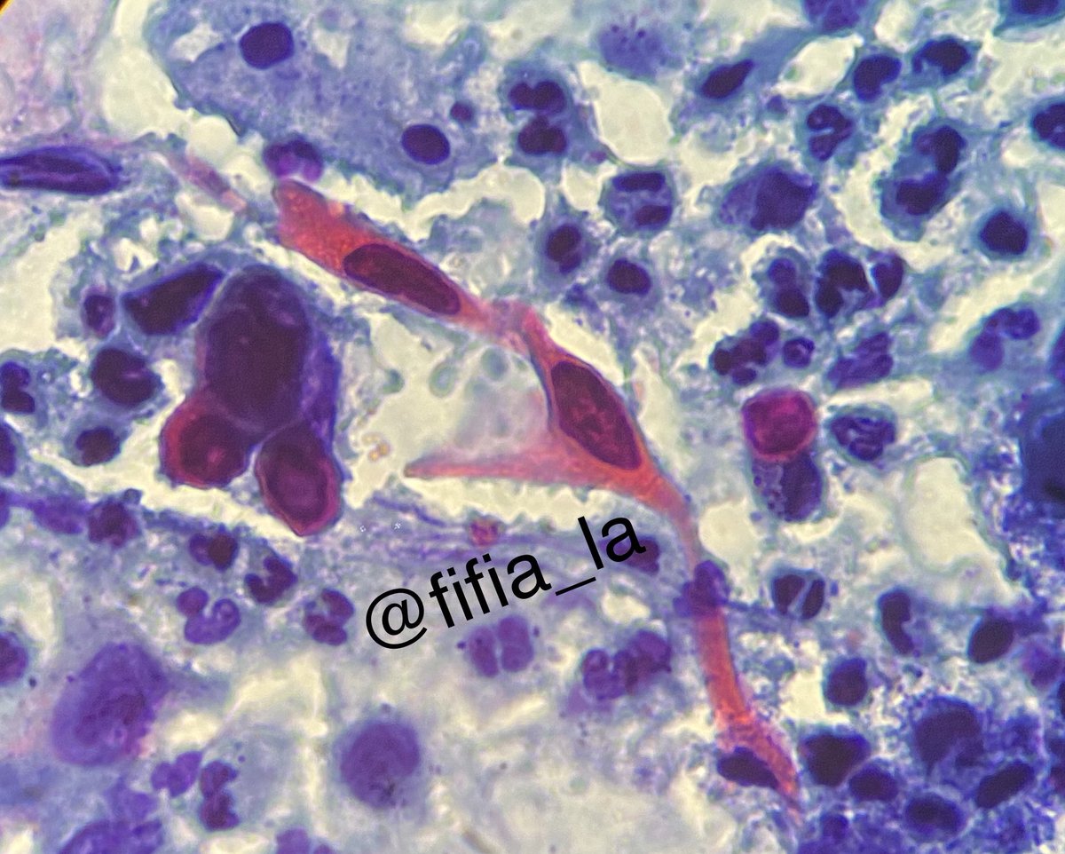 fifia_la's tweet image. Citología cervicovaginal convencional 
#SquamousCellCarcinoma #keratinization 
#TadpokeCells #Macronucleolous #PapSmear