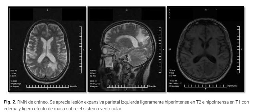 "Linfoma no Hodgkin células B primario del sistema nervioso central en paciente inmunocompetente"
Presentación de caso clínico publicada recientemente y que pueden acceder al texto completo en: revistaccuba.sld.cu/index.php/reva…
<a href="/HCQ_Ameijeiras/">Hospital_Hermanos_Ameijeiras</a> <a href="/MINSAPCuba/">Ministerio de Salud Pública de Cuba</a> <a href="/Anales_ACC/">Anales de la Academia de Ciencias de Cuba</a> <a href="/DrCsLuisVelazq/">Dr.Cs. Luis C. Velázquez Pérez</a>