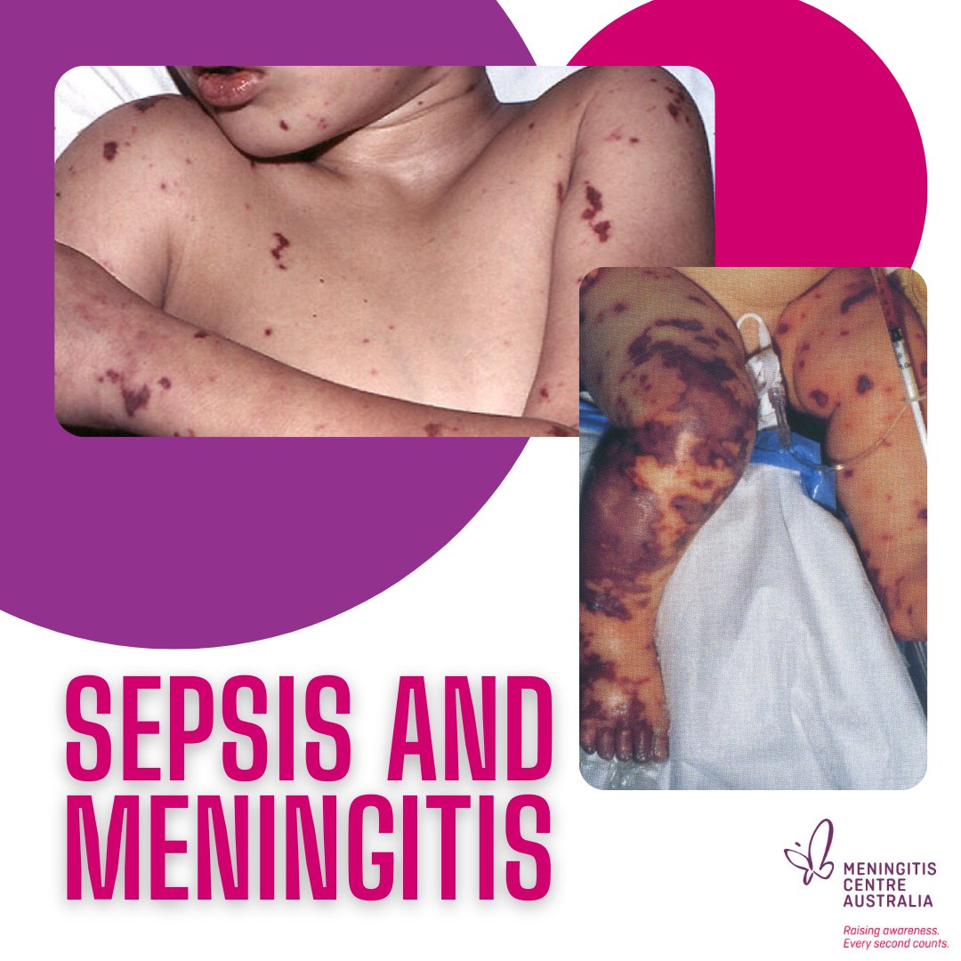 Meningitis Centre Australia (MCA) tweet media