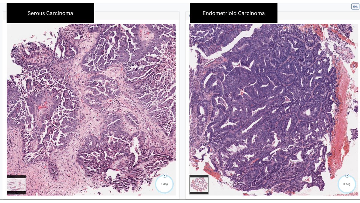 Janiranavarro's tweet photo. Uterus
Serous carcinoma-Morphologic clues
-Diffuse cytologic atypia
Dr. Oliva MGH
🔬Pics #PathPresenter
#everydayGYN #gynpath #PathTwitter #pathology #pathresidents #pathfellow https://t.co/LjEKFKaoOW