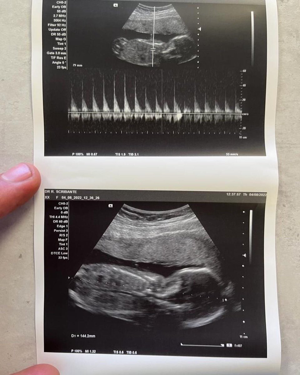 Cruzer244's tweet photo. With our journey with our pregnancy we received 6 visits, 2d scans and emails weekly. To find out more on what @BestmedScheme offers click on the link —> https://t.co/STBiGrzsGB

#58Years #PersonallyYours #MedicalAid #SwitchToBestmed #BestmedRulesApply #JustBeWithBestmed #Ad https://t.co/JTmJpWlYqQ