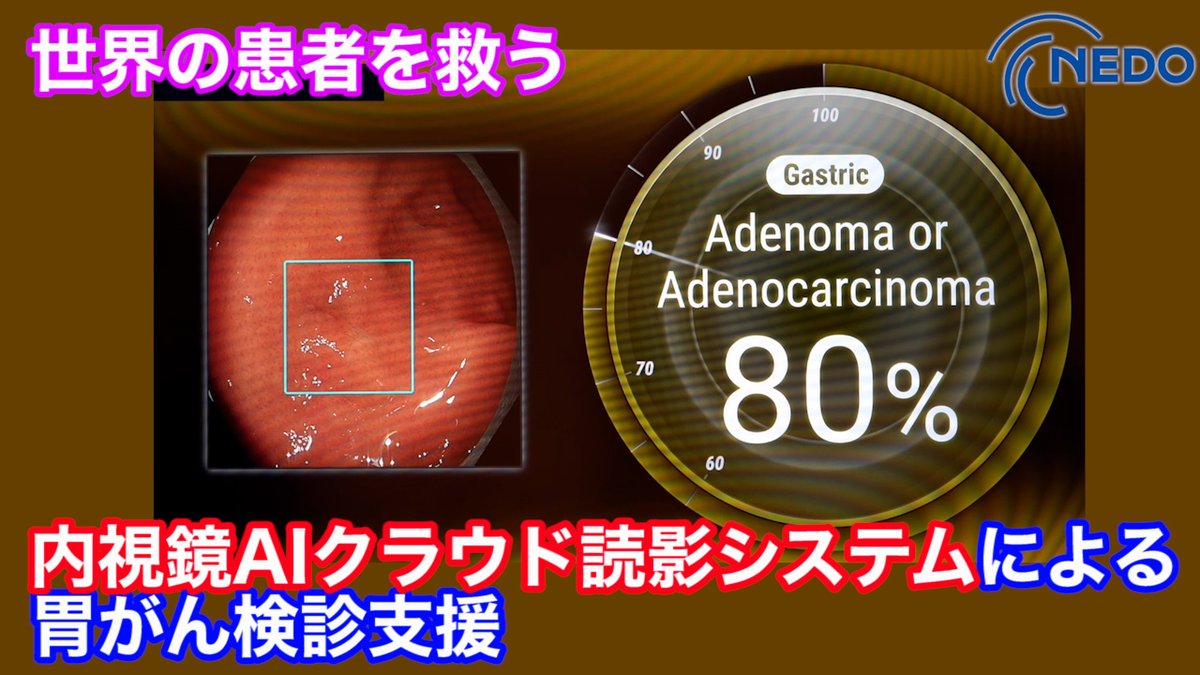 nedo_info's tweet photo. 【ピックアップ】
NEDOの #中小企業・スタートアップ企業 向けポータルサイト「#StarTiPs from NEDO」から『胃がんをAIで早期発見!内視鏡医療の精度向上・均てん化へ』を紹介します。
▼詳細
https://t.co/mOhTR2Om17
#NEDO #スタートアップ #AI https://t.co/RuyjJpLpbw