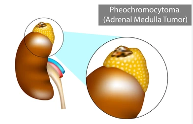 Phaeochromocytomas is a rare, usually noncancerous tumor that develops in an adrenal gland. The tumor develops in specialized cells, located in the center of an adrenal gland.
#phaeochromocytomas #noncancerous #adrenaltumor #hormone #adrenaline #endocrine