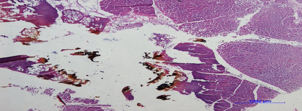 Evaluation of the Best Power Setting of
Laser Waves in Pancreatic...By Lorenzo Dioscoridi
[ISSN 2471-142X]
Read the full article here: bit.ly/3P8JjAv

Manuscript submission click here: bit.ly/2Htkqj5

#openventio #openacess #openjournal #peerreviewed #pancreas