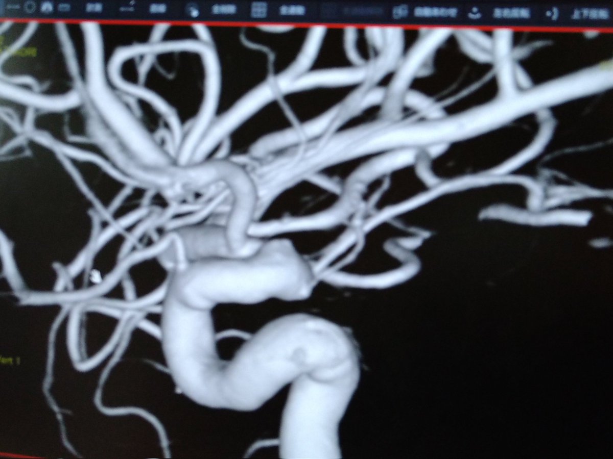 血管の3D感すごない?どうやって手術したのか皆目わからん 