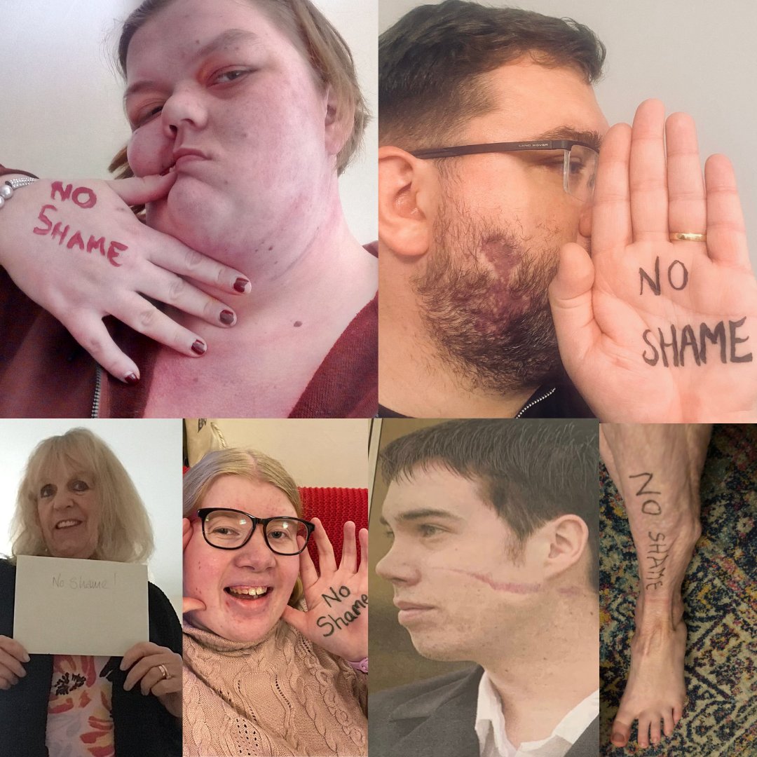 What is a shame is that we’re still perpetuating the myth that there's something wrong with visible differences like scars. 

We hope you will commit to learning about how to better represent those with visible differences. 

Full statement: bit.ly/3Pbokx1
(2/2)