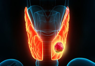 TheAAES's tweet photo. Thyroid cancer is rare in Graves' disease, occurring in less than 2% of the cases. It is more common when there are thyroid nodules seen on ultrasound. #GravesDiseaseAwarenessMonth #GravesDisease #GDAM2022 @GDATF @AmThyroidAssn @TheAACE https://t.co/wLhsgm8dKS