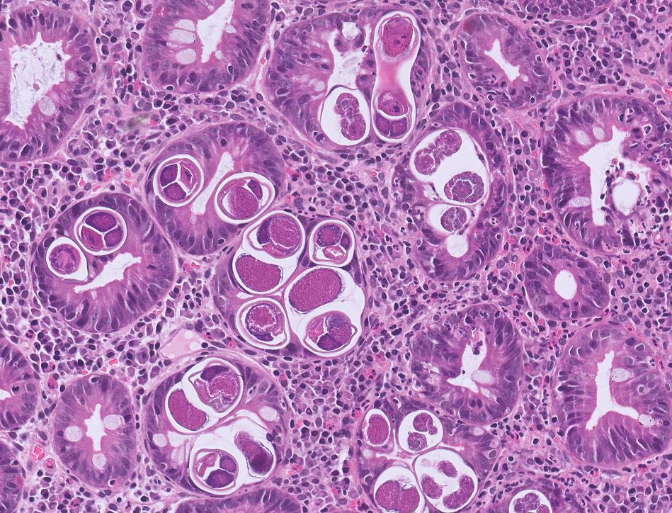 NidaMKhan0's tweet photo. Small intestinal biopsy 🔬
Strongyloidoes Stercoralis infection

#GIpath #PathTwitter #PathResidents #Pathology #PathArt https://t.co/L2cwQniBcz