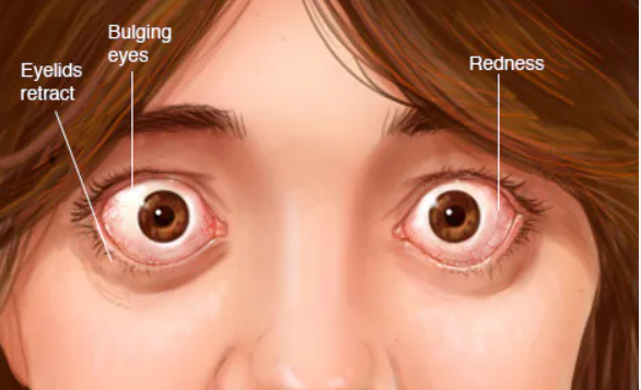 TheAAES's tweet photo. Thyroid eye disease (TED), or Graves' ophthalmopathy, occurs in 30% of patients with Graves' disease. Symptoms include red eyes, tearing, dry eyes, a gritty sensation, and/or sensitivity to light.  #GravesDiseaseAwarenessMonth #GDAM2022 @GDATF @AmThyroidAssn @TheAACE https://t.co/k2zfwxBef2