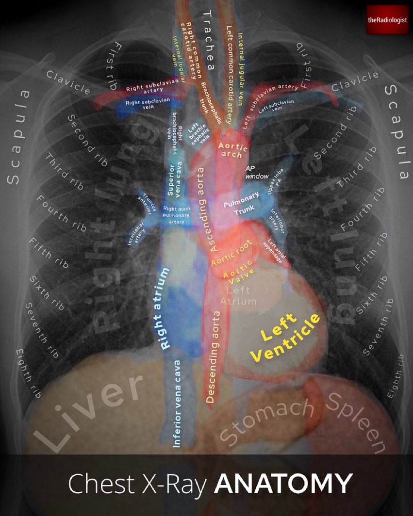 Paul_Wischmeyer's tweet image. Best chest x-ray anatomy guide ever 🫁  
#MedEd #Medtwitter #TipsForNewDocs #medicine #MedicalStudents #FOAMed #FOAMcc 

Via @radiologistpage