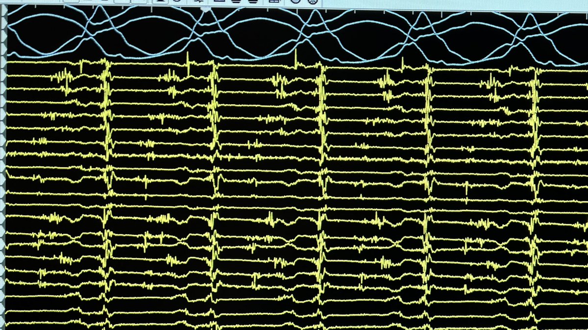 Alexios Hadjis (@alexioshadjis) on Twitter photo Diastolic BUFFET
ischemic cmp w/ incessant VT despite amio/lido/BB and multiple cardioversions. Non indicible with 4 extrastim after targeting all diast activity. Thanks to <a href="/NRamdoyal/">Nilesh Ramdoyal</a> for the hemodynamic support #AblateVT Diastolic BUFFET
ischemic cmp w/ incessant VT despite amio/lido/BB and multiple cardioversions. Non indicible with 4 extrastim after targeting all diast activity. Thanks to <a href="/NRamdoyal/">Nilesh Ramdoyal</a> for the hemodynamic support #AblateVT