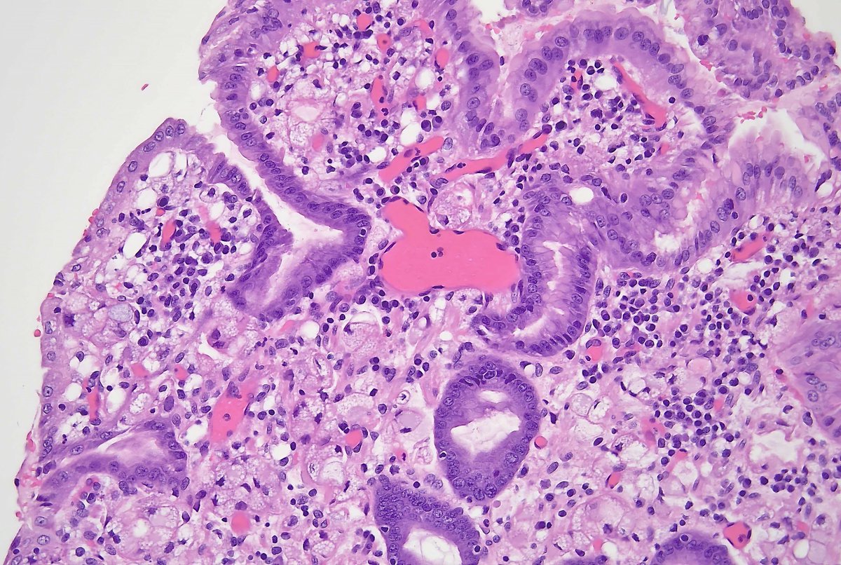 Xanthoma or signet rings? This case shared with me by a brilliant colleague made me look twice. 😓 #GIpath