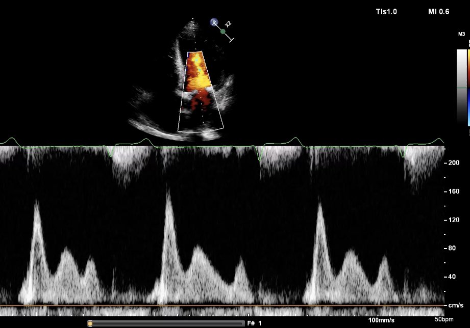 And here? #echofirst what about filling pressures?