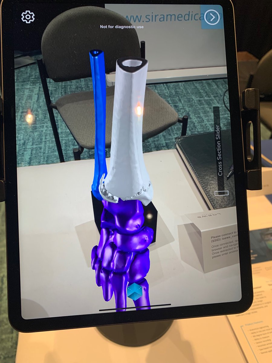 Excited to be showing our #AugmentedReality technology for #Orthopedics at #POSNA #IPOS22 in Orlando this week! #MedEd #pedsortho @siramedical @RickBeberman