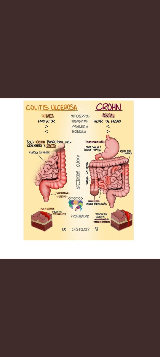 Diferencias entre Colitis Ulcerosa y E. Crohn