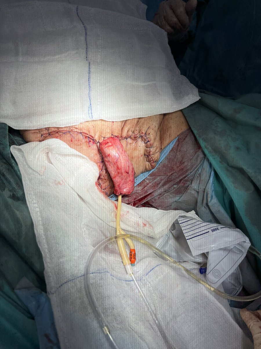 Scrotal elephantiasis 2 years after treatment of penile carcinoma. #UroSoMe <a href="/olejnik_raf/">Rafał Olejnik</a> <a href="/PopiolekMarcin/">Marcin Popiolek</a> <a href="/jackchelchowski/">Jacek Chełchowski</a> <a href="/JobczykMateusz/">Mateusz Jobczyk</a> <a href="/MarcinJarzemski/">Marcin Jarzemski</a> <a href="/PrzemyslawZugaj/">Przemysław Zugaj</a> <a href="/wojciechpiotrk1/">wojciech_piotr_krajewski</a> <a href="/MMokrzys/">Mateusz Mokrzyś</a> <a href="/TayaraOmar/">Omar Tayara</a> @Filip73887202 <a href="/SlupskiPiotr/">Piotr Slupski</a> @GoumasUrologia <a href="/Urologeman/">Urologeman (Nariman Gadzhiev)</a>